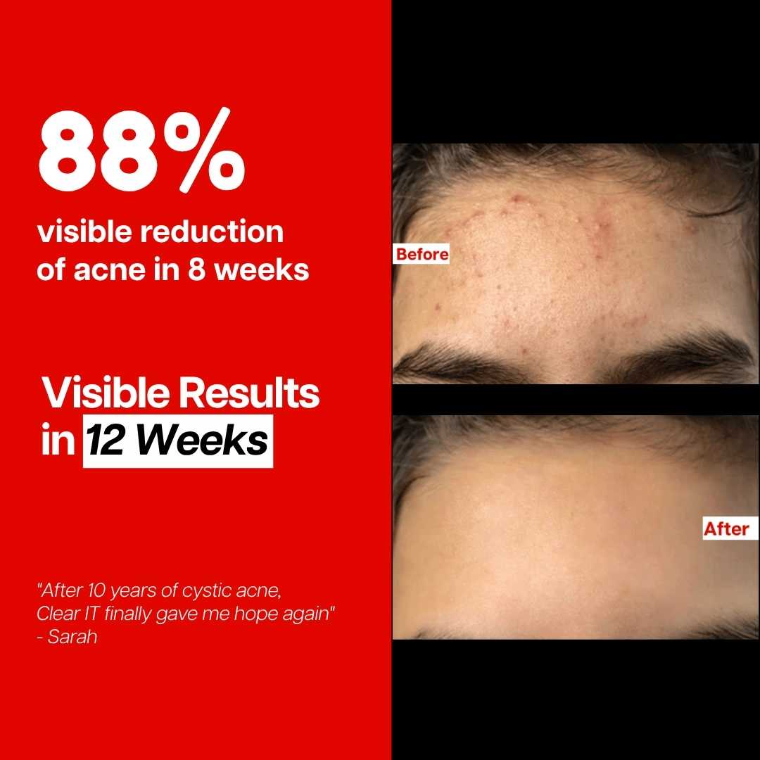 Ventamin Clear It+: Doctor-Formulated Drink Mix for Acne & Breakout Control