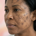 Dark spots that won’t fade away