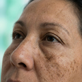Melasma on cheeks and forehead