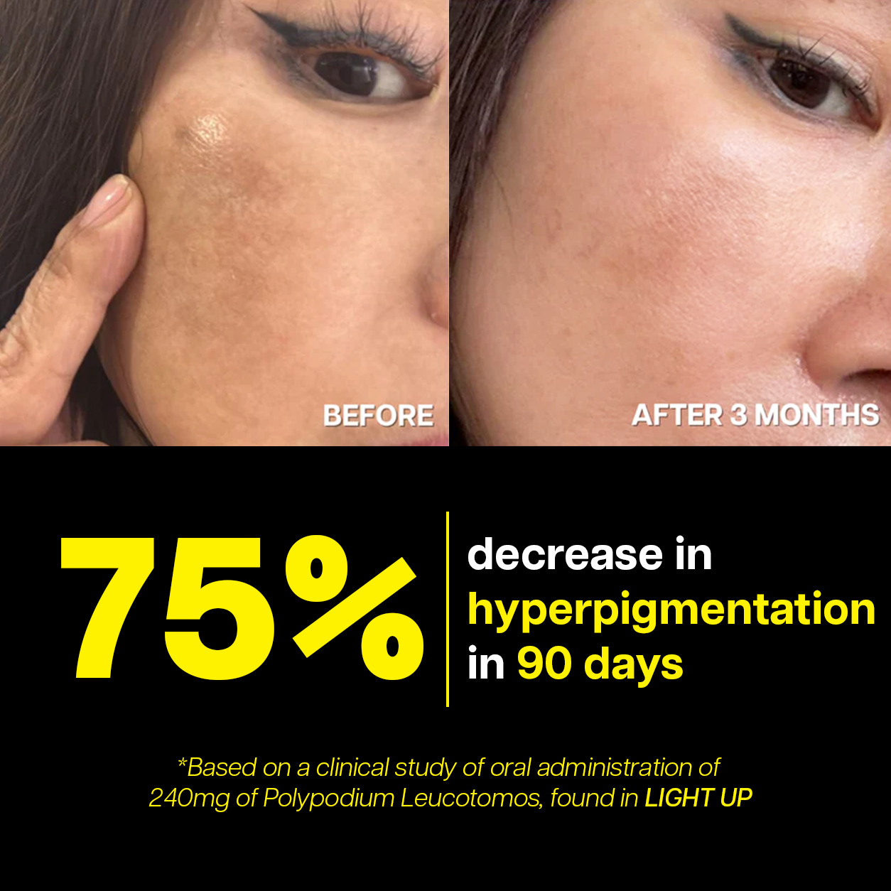 Ventamin Light Up: Doctor-Formulated Brightening Formula for Melasma, Acne scars & Hyperpigmentation