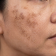 Melasma from hormones or sun